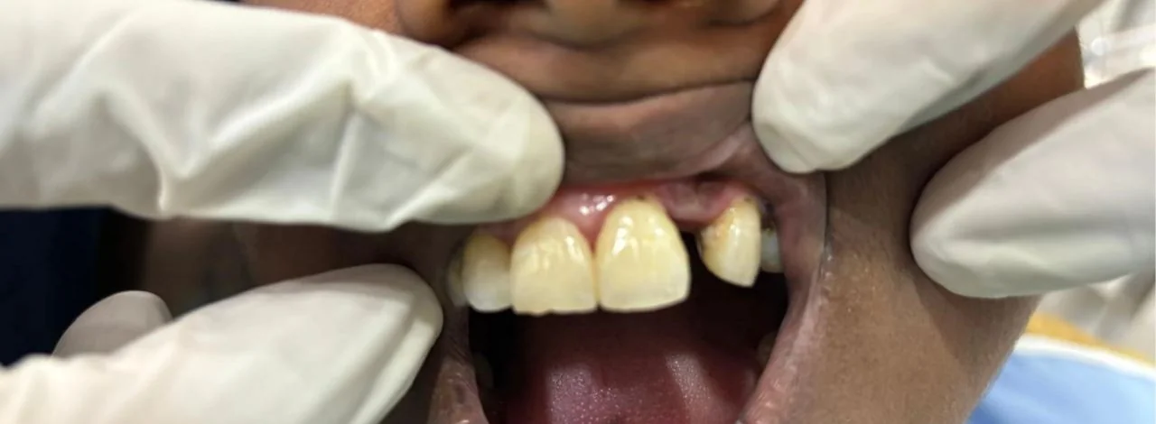 Patient case 1 before treatment at S & I Dental Clinic