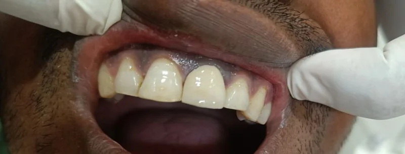 Patient case 2 after treatment at S & I Dental Clinic