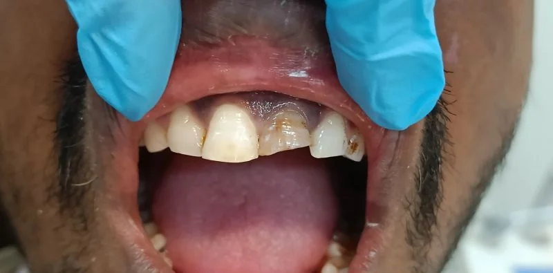 Patient case 2 before treatment at S & I Dental Clinic