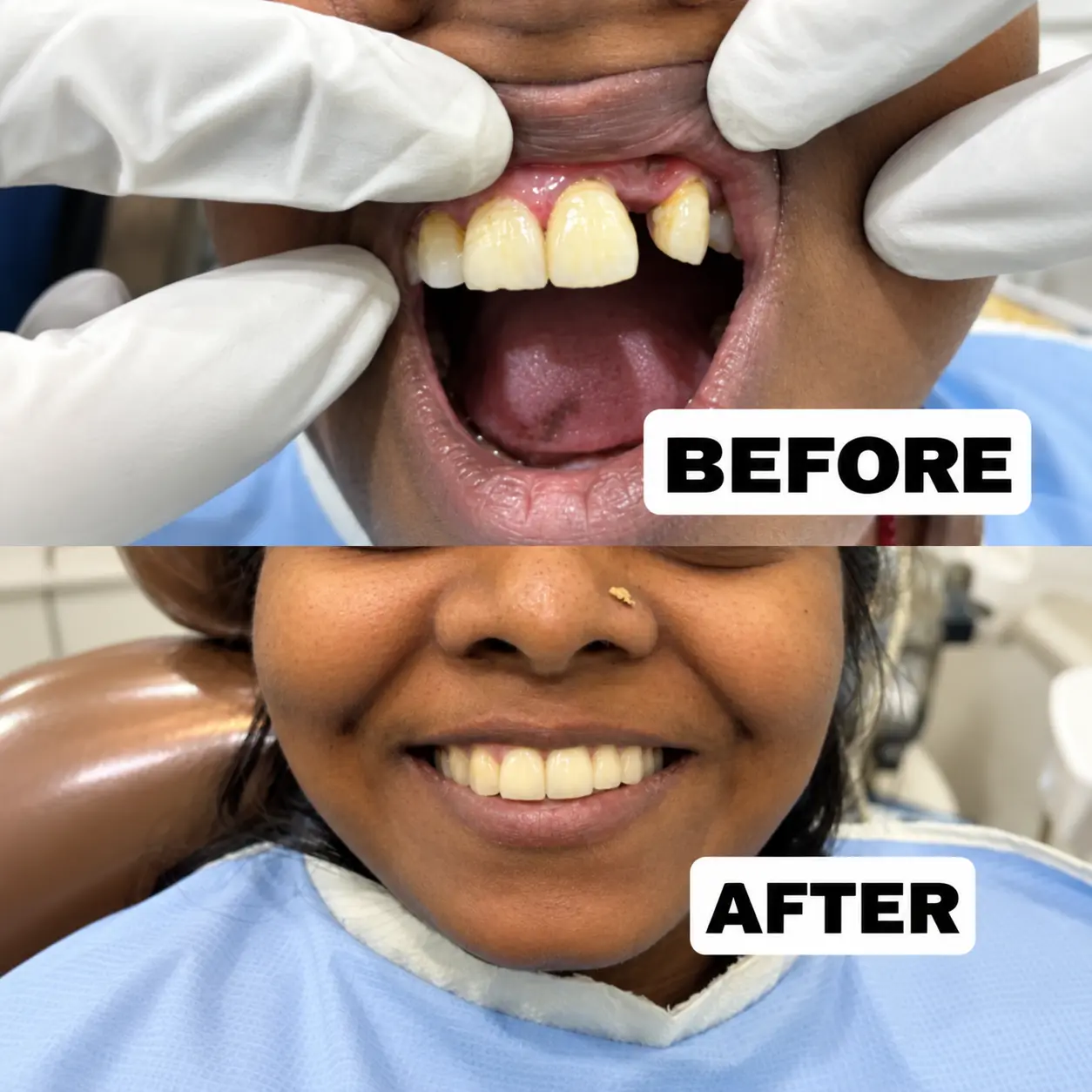 Before & After Dental implant at S & I Dental Clinic