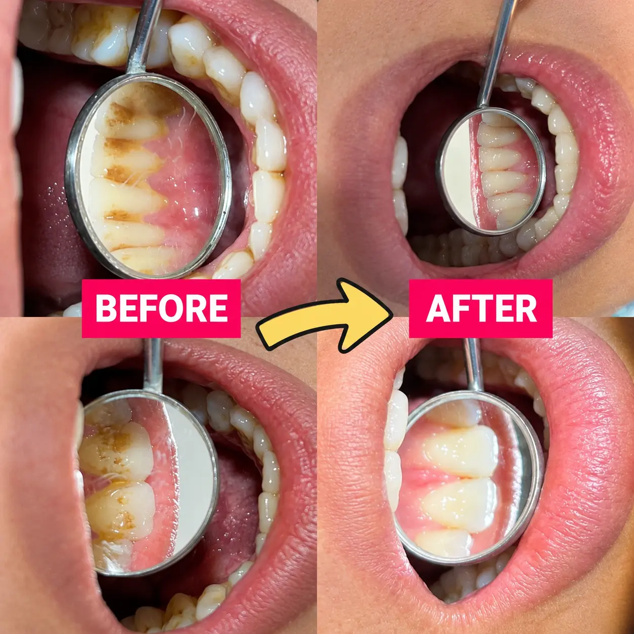 Before & After Dental Cleaning at S & I Dental Clinic