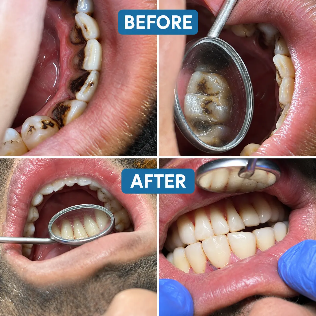Before & After Dental Cleaning at S & I Dental Clinic